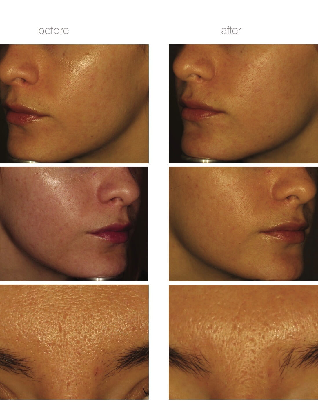 kayla's experience with venus viva skin resurfacing for textural acne scars