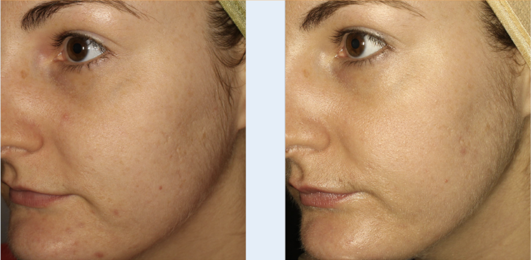 before + after micro-needling for acne scars