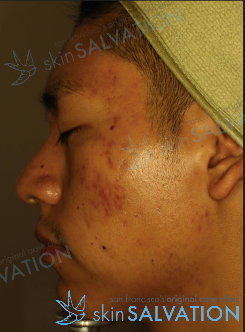 san francisco's original holistic acne skincare clinic – with & within by  skinsalvation skincare inc.